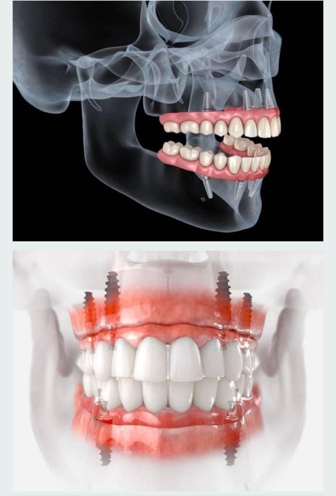 Implant Retained Dentures